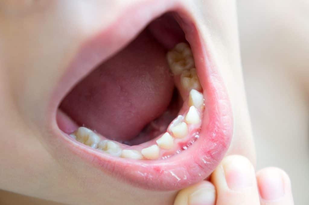 Comment gérer l'angoisse d'une dent qui bouge conseils et solutions